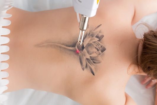 A person undergoing laser tattoo removal 